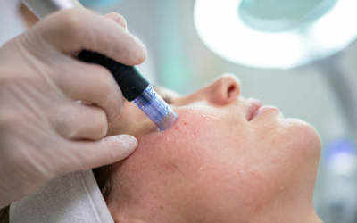 Microneedling vs. Chemical Peels: Which Is Better for Acne Scars?