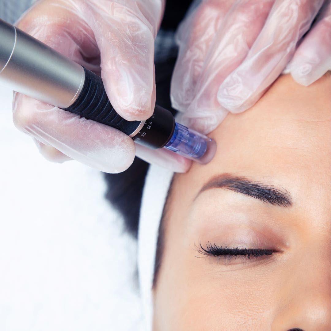 Medical-grade microneedling pen treating the skin