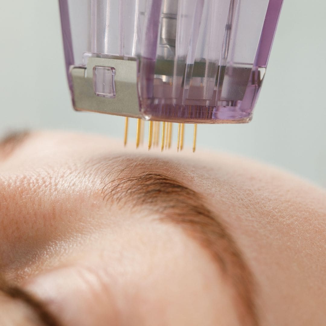 Microneedling pen treating the forehead