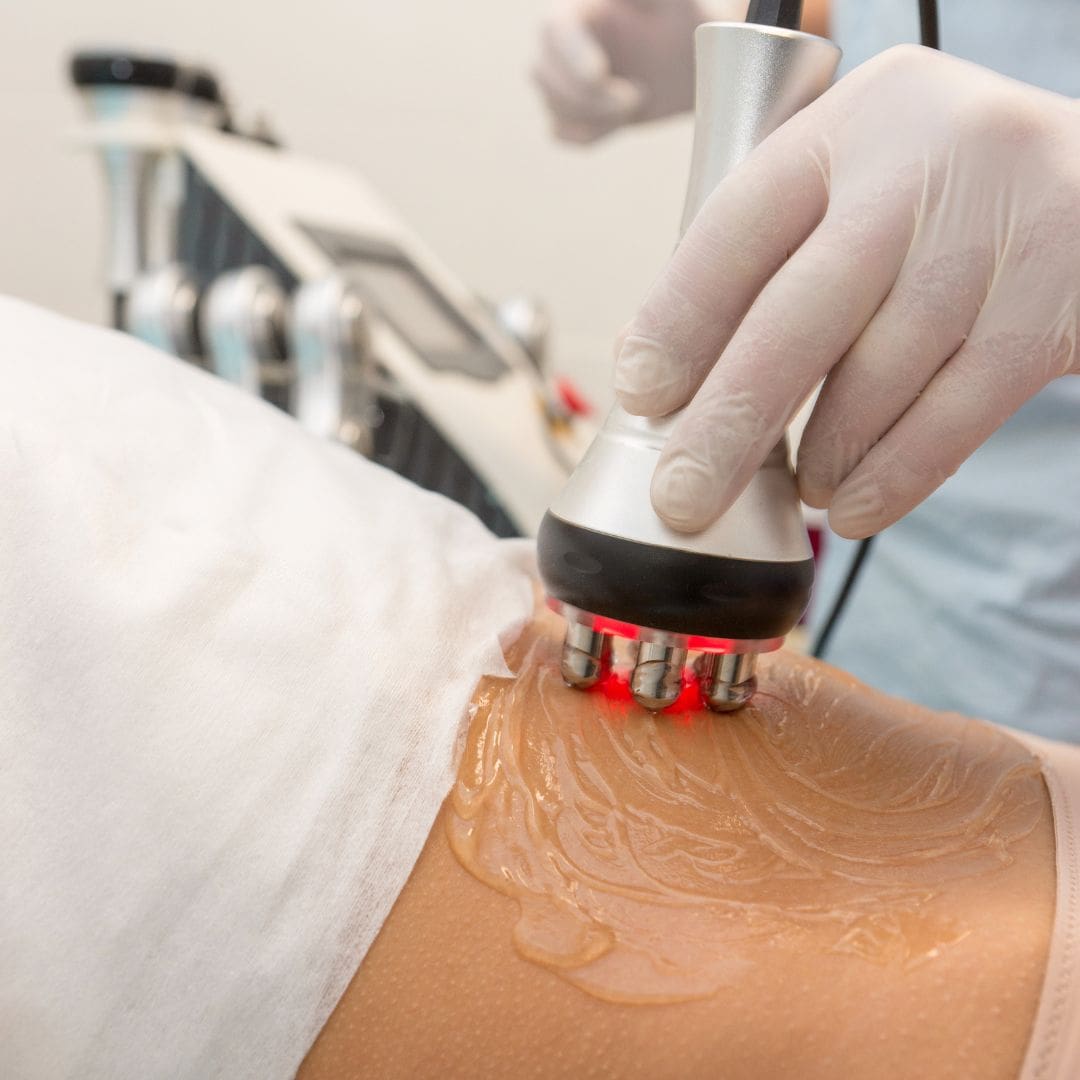 TriPollar skin tightening device used on a client